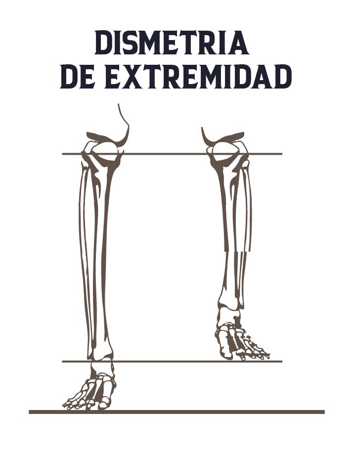 proceso de alargamiento con fijador externo y clavo endomedular-10